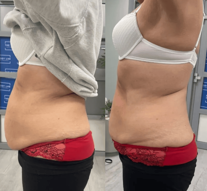 Fat freezing Swindon